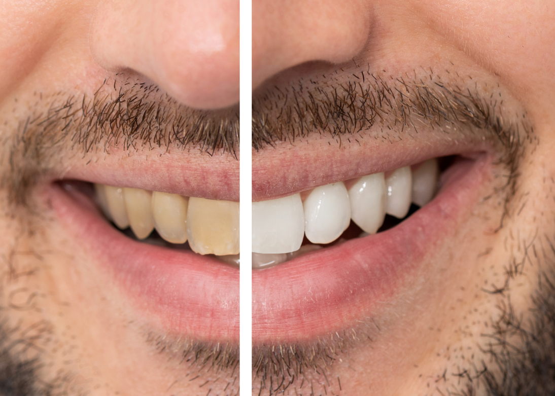 Teeth Whitening